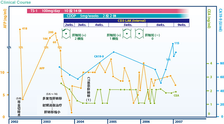 日本免疫細胞治療(瀨田診所)：胃癌，女，62歲